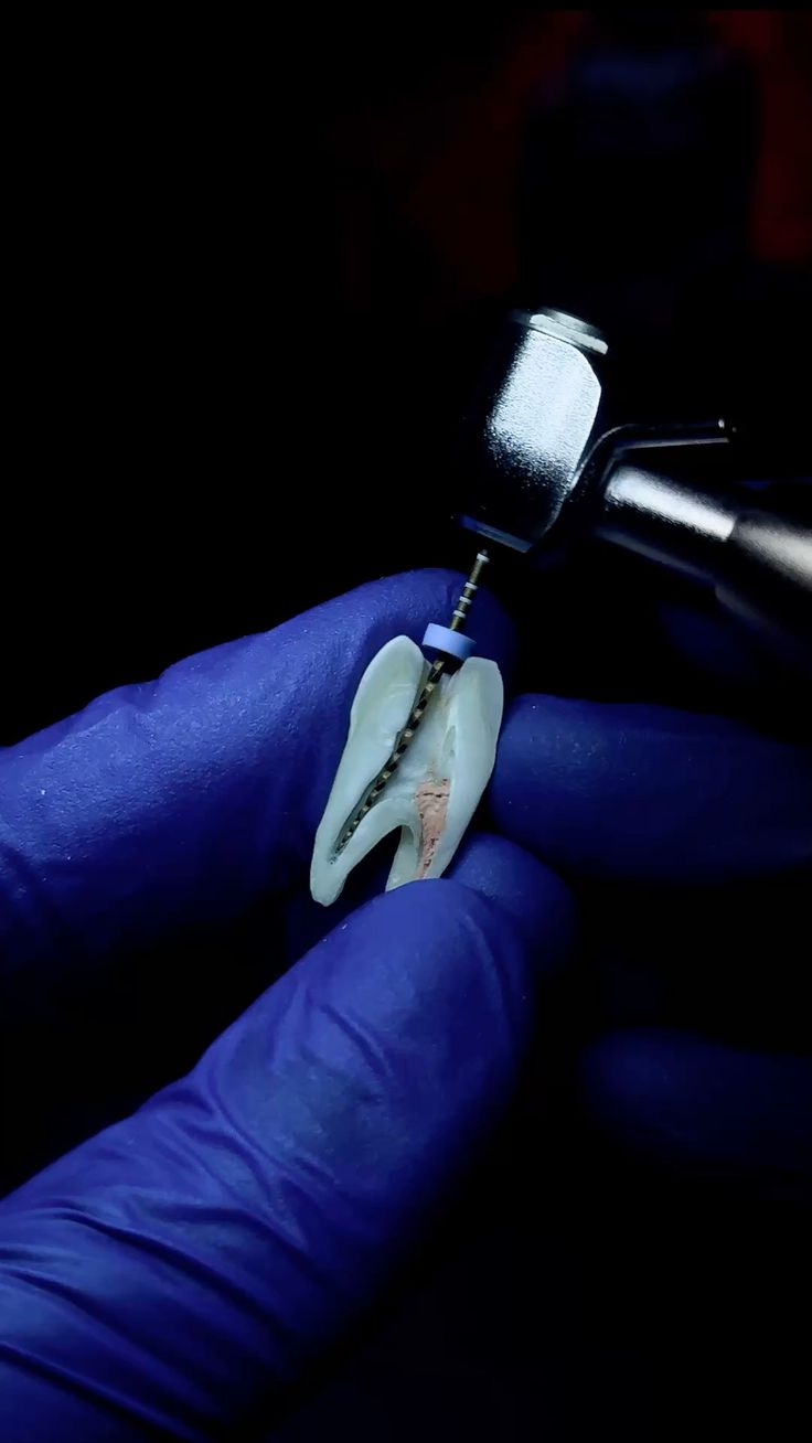 Endodontic treatment being demonstrated on a tooth model