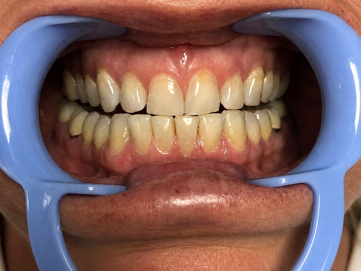 Patient's smile before treatment in Smile Story 02
