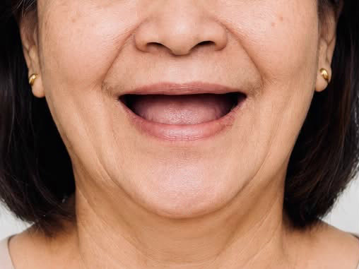 Patient's smile before treatment in Smile Story 04
